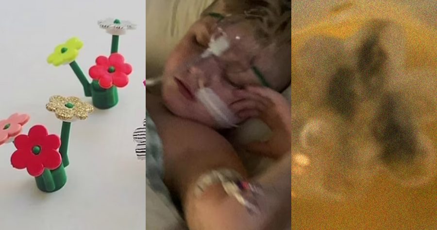 Anak batuk sejak 5 tahun lalu, rupanya ada bunga mainan tersangkut dalam kerongkong